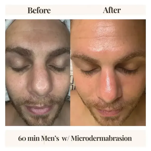 Before and after men's facial